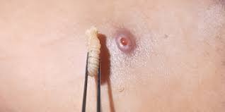 Registran 16 casos de gusano barrenador en humanos