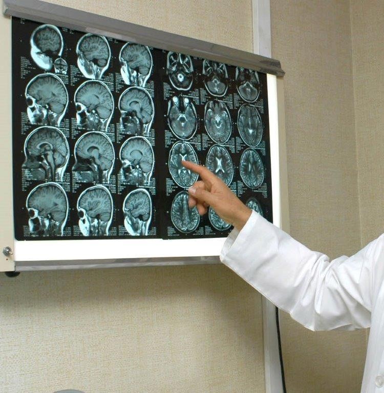 Orienta IMSS Yucatán sobre epilepsia y servicios que otorga ante esta afección