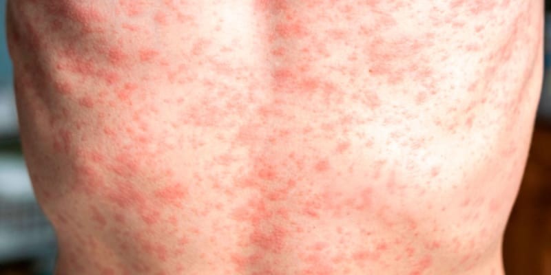 Acumula Yucat&aacute;n 15 casos de sarampi&oacute;n