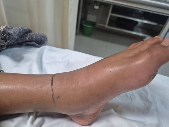 Cuidado con ataques de culebras