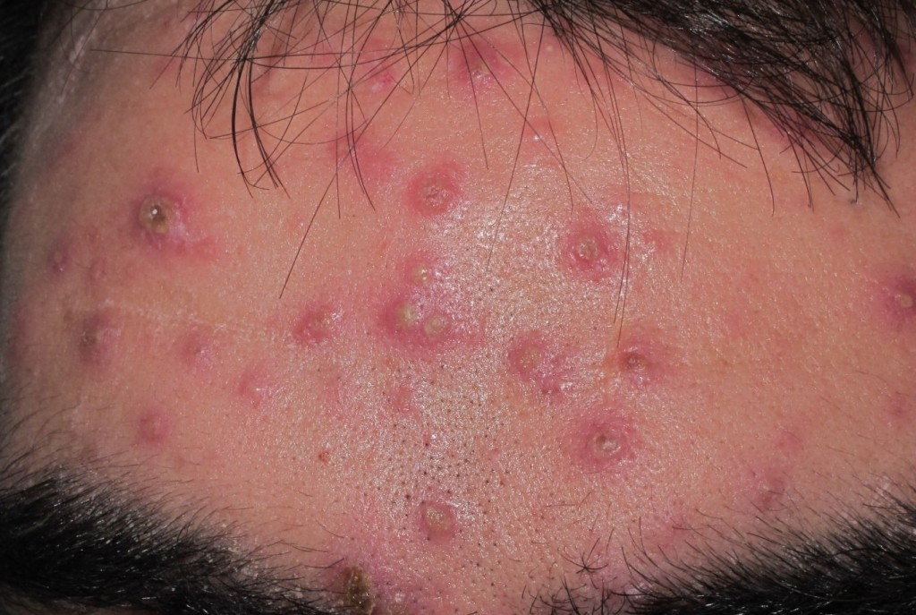 Se contagia m&aacute;s cuando hay calor la Varicela, que registra m&aacute;s de 500 casos, en Yucat&aacute;n