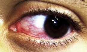 Síndrome del ojo seco muy común y poco diagnosticado
