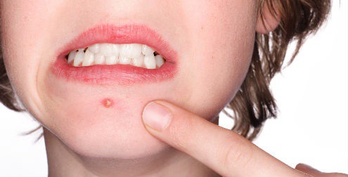 Jóvenes que tienen acné sufren bullyng