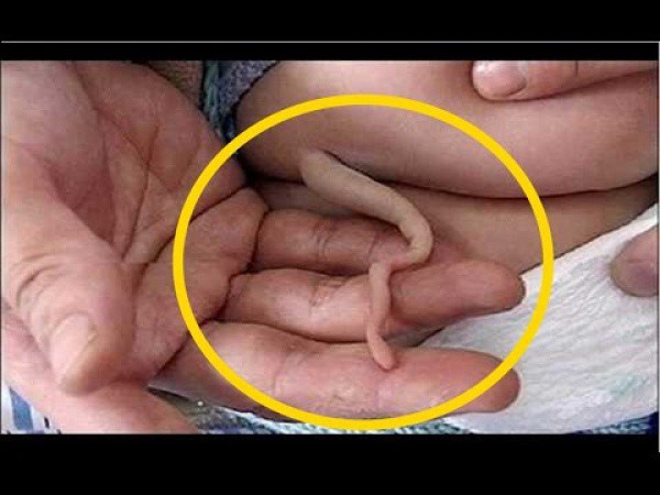 Bebé chino nació con una cola