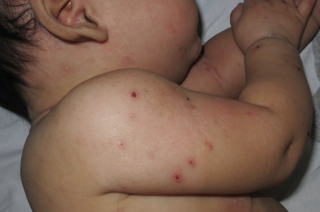 Aumentan los casos de varicela en Yucatán