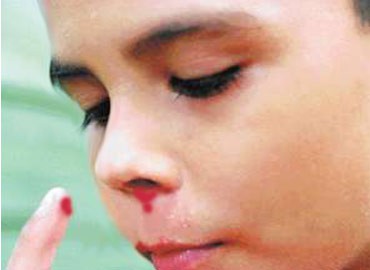 Unos 350 yucatecos viven con hemofilia