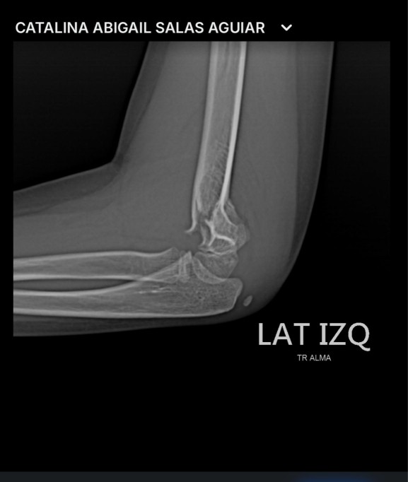 Niña se fractura un brazo en Xtreme Jumping y el lugar no contaba con primeros auxilios ni con botiquín Niña se fractura un brazo en Xtreme Jumping y el lugar no contaba con primeros auxilios ni con botiquín
