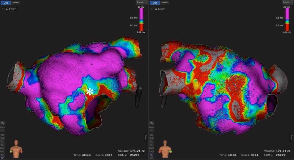 IMSS Bienestar incorpora sistema de mapeo electroanatómico para el tratamiento de arritmias en el HRAEPY