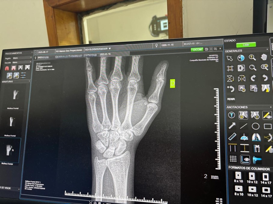 Promueve IMSS Yucatán cuidado de salud ósea para prevenir complicaciones