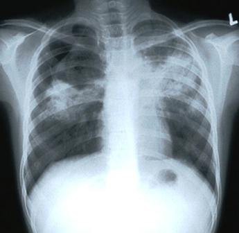 Se diagnostican 180 casos de tuberculosis pulmonar al año en Yucatán