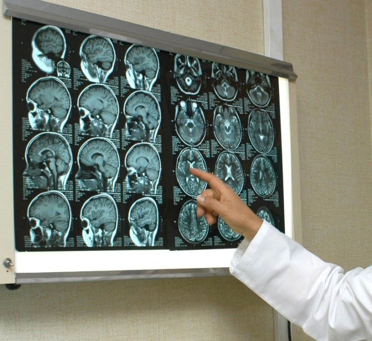 Ratifica IMSS Yucatán atención diagnóstica y mejora tiempo de respuesta con Código Cerebro