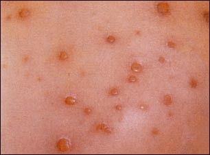 Aumentan los casos de varicela en los primeros meses del 2013 