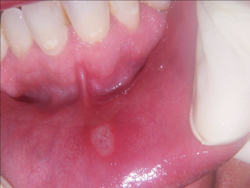 Aftas bucales, pequeñas lesiones que afecta la cavidad oral